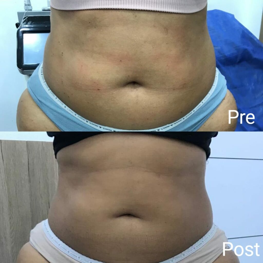 حقن تخسيس موضعي لنحت البطن و الجناب